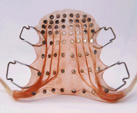 5d6519e3e1e4e.jpg 假腭.jpg